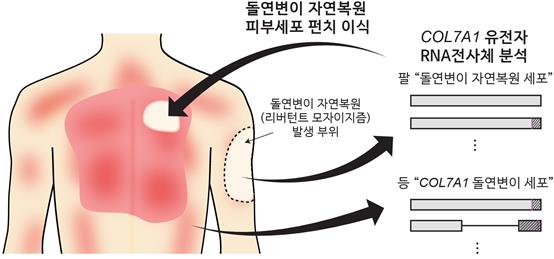 '가벼운 마찰에도 상처·수포' 희귀피부병 국내서 치료법 찾았다[연합뉴스]